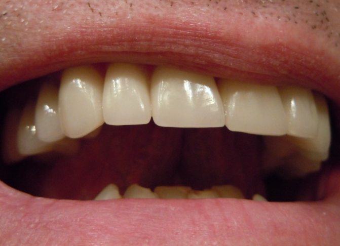 Стоматолог Дахкильгов назвал оптимальную периодичность чистки зубов