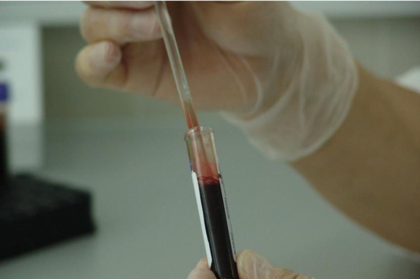 Аутоиммунный гепатит: что известно о редкой форме заболевания печени